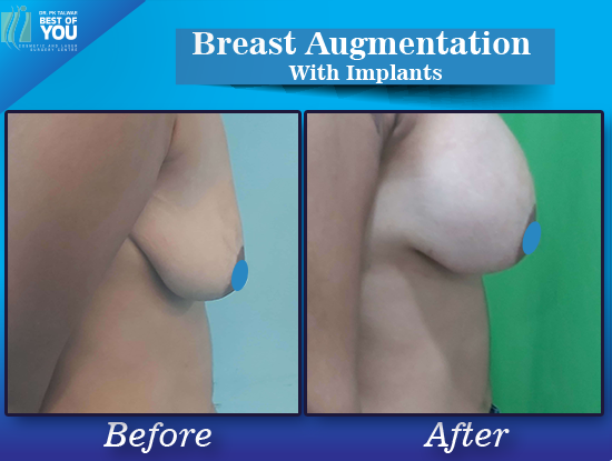 Breast Augmentation with implant result